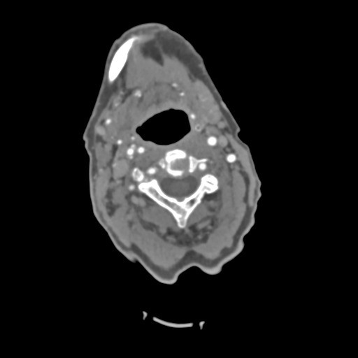 C2 fracture with vertebral artery dissection (Radiopaedia 37378-39200 A 153).png
