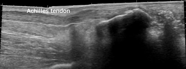 File:Calcaneal tuberosity avulsion fracture - ultrasound (Radiopaedia 29978-30524 B 1).jpg