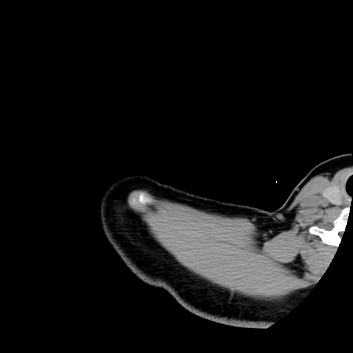 Calcific tendinitis of the infraspinatus tendon (Radiopaedia 87256-103539 B 9).jpg