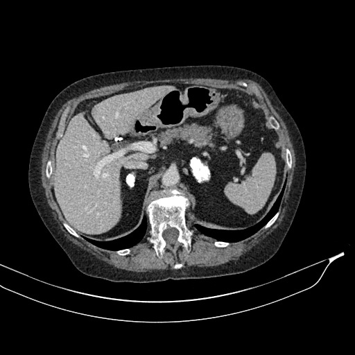 Calcified adrenal glands and Spigelian hernia (Radiopaedia 49741-54988 A 56).jpg