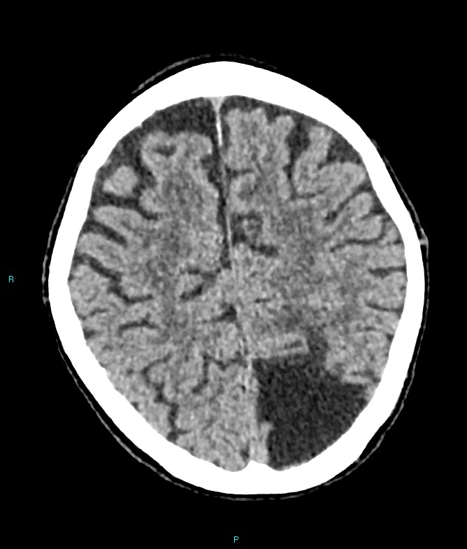 Calcified cerebral emboli from left ventricular thrombus (Radiopaedia 84420-99758 Axial non-contrast 29).jpg