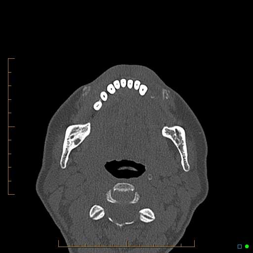 Calcified facial augmentation fillers (Radiopaedia 79514-92679 Axial bone window 124).jpg