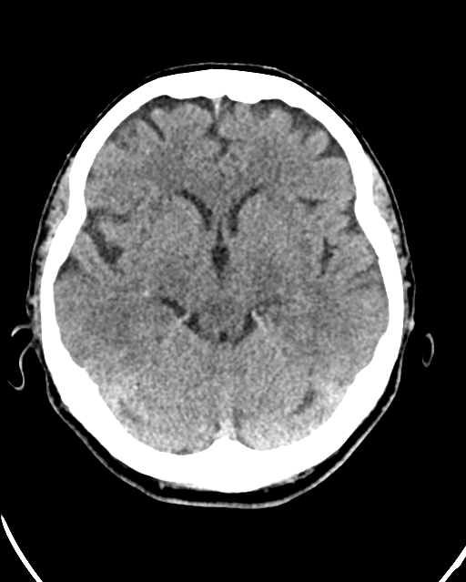 Calcified meningioma (Radiopaedia 74361-85243 Axial non-contrast 31).jpg