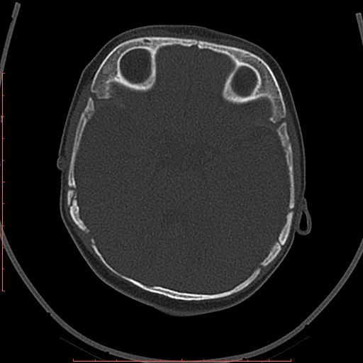 File:Calcified middle cerebral artery embolism (Radiopaedia 78949-91860 Axial bone window 16).jpg