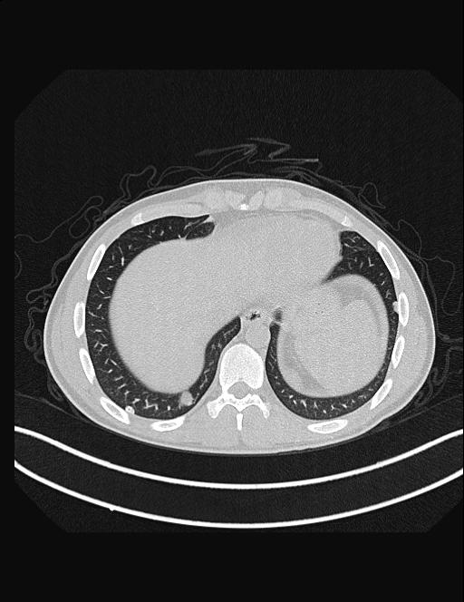 Calcifying pulmonary metastases (Radiopaedia 33359-34396 Axial lung window 51).jpg