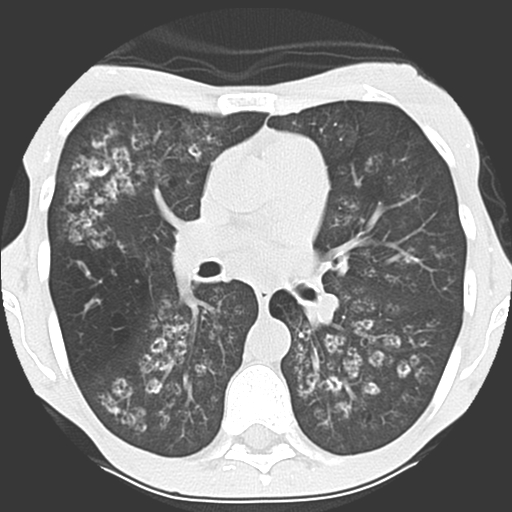 File:Calciphylaxis and metastatic pulmonary calcification (Radiopaedia 10887-11317 Axial lung window 21).jpg