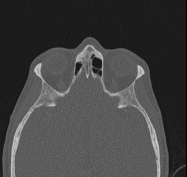 Caldwell-Luc operation (Radiopaedia 52329-58225 Axial bone window 18).jpg