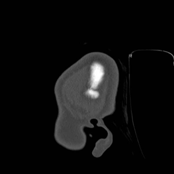 Calvarial osteoma (Radiopaedia 36520-38079 Sagittal bone window 105).jpg