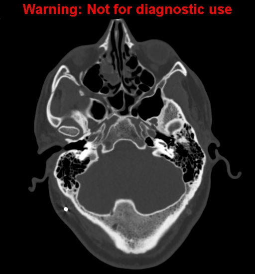 File:Calvarial thickening from chronic shunting (Radiopaedia 60079-67637 Axial bone window 33).jpg