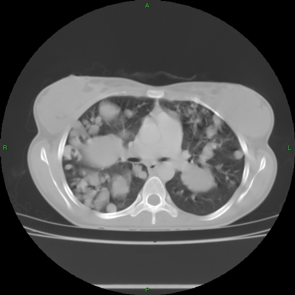 File:Cannon ball metastases - synovial sarcoma (Radiopaedia 26135-26271 Axial lung window 16).jpg