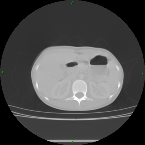 File:Cannon ball metastases - synovial sarcoma (Radiopaedia 26135-26271 Axial lung window 40).jpg