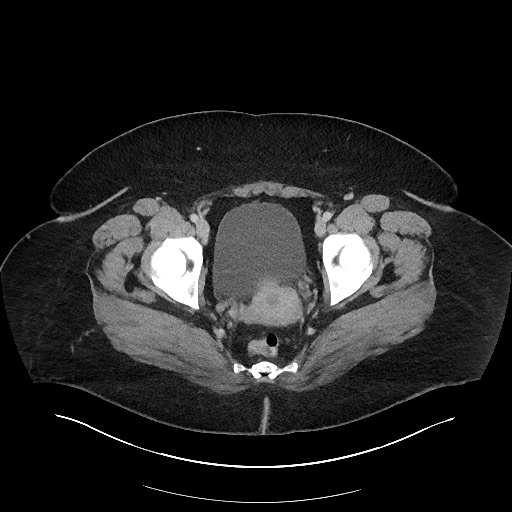 File:Carcinoid tumor - terminal ileum (Radiopaedia 60931-68739 A 124).jpg