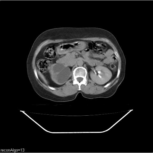 Carcinoma cervix- recurrence (Radiopaedia 34702-36137 B 70).jpg