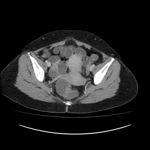 File:Carcinoma colon - hepatic flexure (Radiopaedia 19461-19493 A 112).jpg