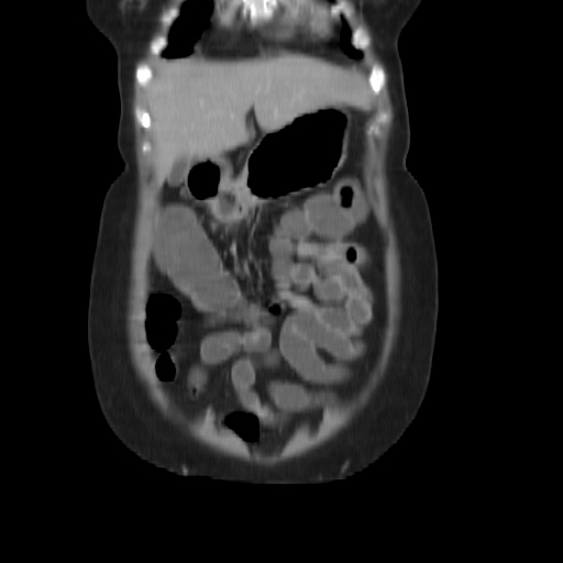 File:Carcinoma colon - hepatic flexure (Radiopaedia 19461-19493 B 6).jpg