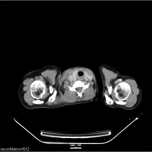 File:Carcinoma of esophagus (Radiopaedia 27356-27550 A 34).jpg