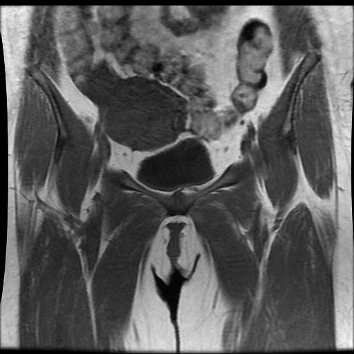 File:Carcinoma of the cervix (Radiopaedia 89018-105858 Coronal T1 3).jpg