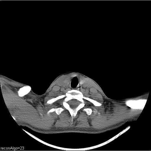Carcinoma of the maxillary antrum (Radiopaedia 53805-59888 Axial non-contrast 12).jpg