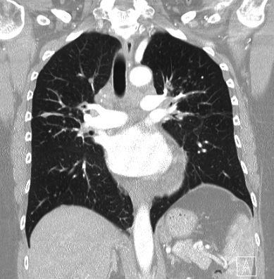 Cardiac sarcoidosis (Radiopaedia 74548-85534 Coronal lung window 36).jpg