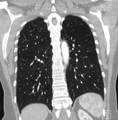 Cardiac sarcoidosis (Radiopaedia 74548-85534 Coronal lung window 50).jpg