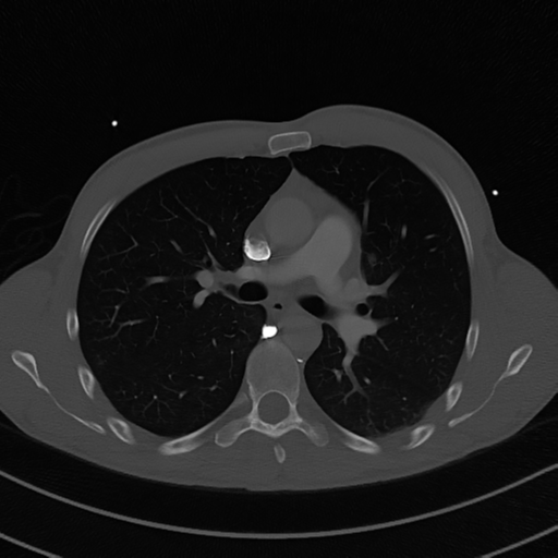 Cardiac tumor - undifferentiated pleomorphic sarcoma (Radiopaedia 45844-50134 Axial bone window 29).png