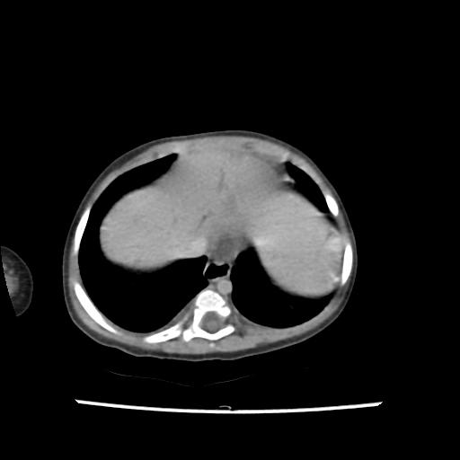 Caroli disease with autosomal recessive polycystic kidney disease (ARPKD) (Radiopaedia 89651-106703 B 16).jpg