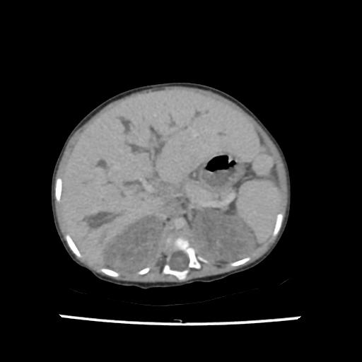 File:Caroli disease with autosomal recessive polycystic kidney disease (ARPKD) (Radiopaedia 89651-106703 B 63).jpg