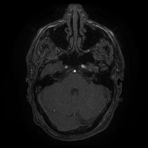 Carotid arterial dissection with acute cerebral infarction (Radiopaedia 26636-26784 MRA 130).jpg