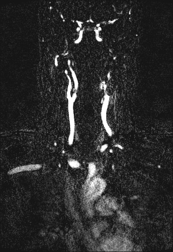 Carotid artery dissection (Radiopaedia 28441-28689 Coronal MRA 34).jpg
