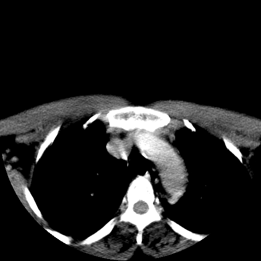 File:Carotid body tumor (Radiopaedia 27890-28124 A 36).jpg