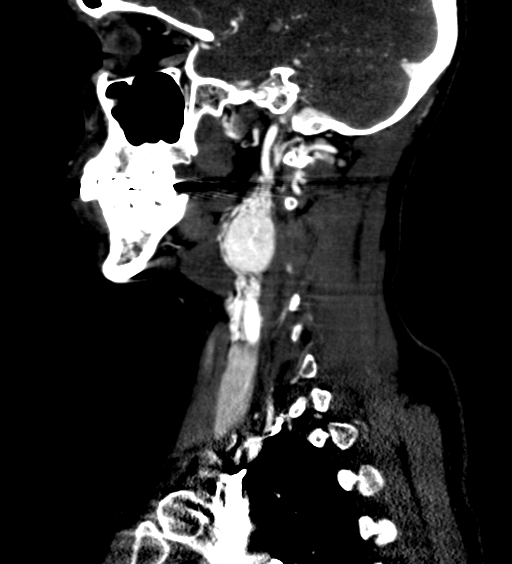 File:Carotid body tumor (Radiopaedia 39845-42300 D 39).jpg