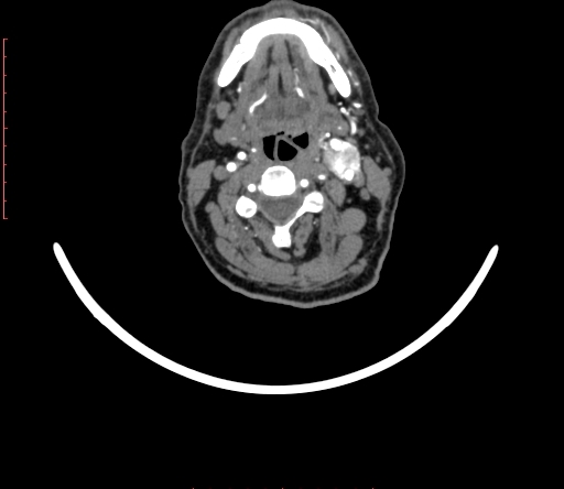 Carotid body tumor (Radiopaedia 66785-76116 B 38).jpg