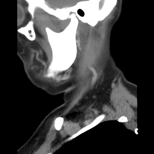 File:Carotid body tumor (paraganglioma) (Radiopaedia 38586-40729 C 8).jpg