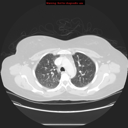 File:Carotid body tumor with lung metastases (Radiopaedia 9301-48390 Axial lung window 25).jpg