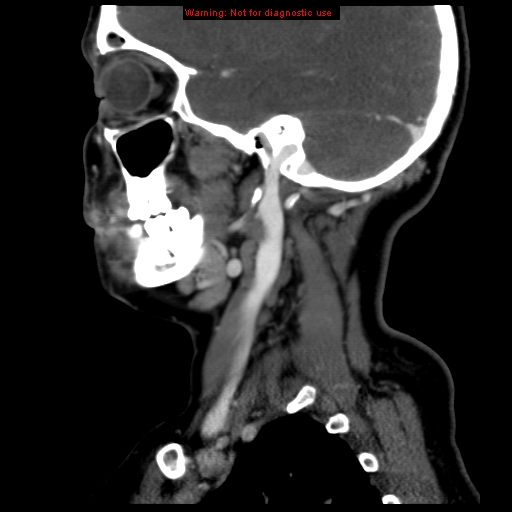 Carotid body tumor with lung metastases (Radiopaedia 9301-9986 Sagittal C+ delayed 13).jpg