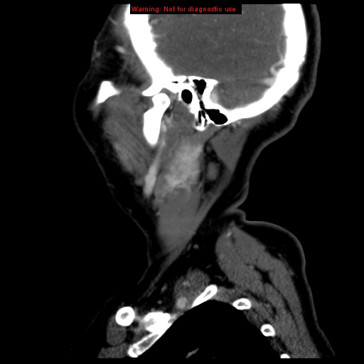 File:Carotid body tumor with lung metastases (Radiopaedia 9301-9986 Sagittal C+ delayed 45).jpg