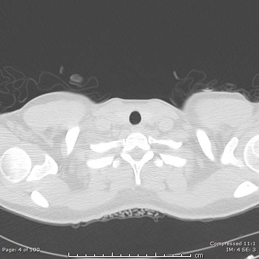 Catamenial pneumothorax (Radiopaedia 54382-60600 Axial non-contrast 4).jpg