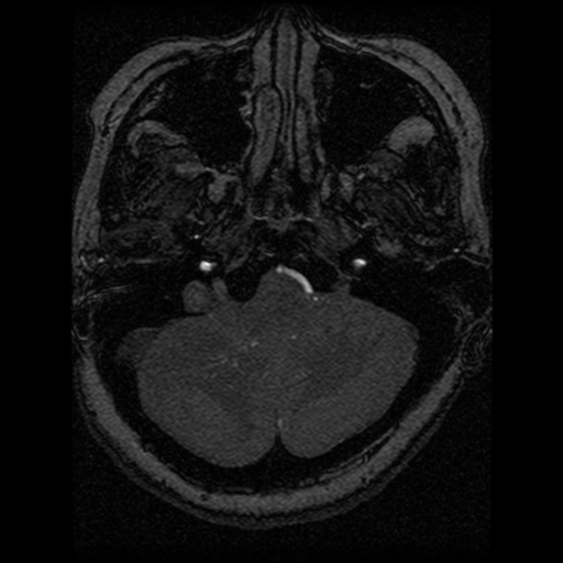 Cavernoma, DVA and right ICA aneurysm (Radiopaedia 33890-35072 E 93).png