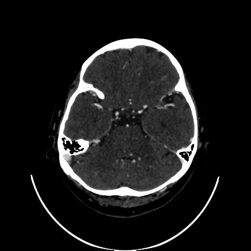 Cavernoma with developmental venous anomaly (Radiopaedia 22470-22506 C 43).jpg