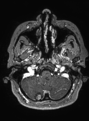 Cavernous hemangioma of the cerebellar falx (Radiopaedia 73025-83724 Axial T1 C+ 290).jpg