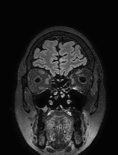 Cavernous hemangioma of the cerebellar falx (Radiopaedia 73025-83724 Coronal FLAIR 47).jpg