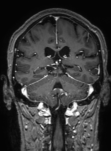 Cavernous hemangioma of the cerebellar falx (Radiopaedia 73025-83724 Coronal T1 C+ 239).jpg