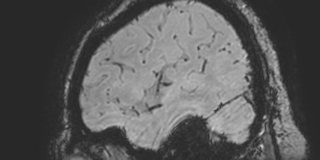 Cavernous hemangioma of the cerebellar falx (Radiopaedia 73025-83724 Sagittal BOLD 33).jpg