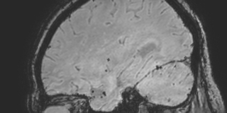 Cavernous hemangioma of the cerebellar falx (Radiopaedia 73025-83724 Sagittal BOLD 55).jpg