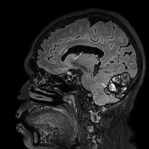 Cavernous hemangioma of the cerebellar falx (Radiopaedia 73025-83724 Sagittal FLAIR 126).jpg