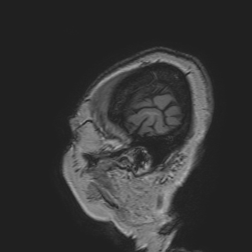 File:Cavernous hemangioma of the cerebellar falx (Radiopaedia 73025-83724 Sagittal T1 17).jpg
