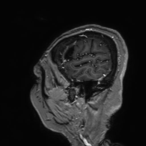 Cavernous hemangioma of the cerebellar falx (Radiopaedia 73025-83724 Sagittal T1 C+ 24).jpg