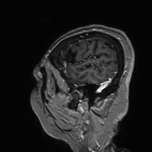 Cavernous hemangioma of the cerebellar falx (Radiopaedia 73025-83724 Sagittal T1 C+ 27).jpg
