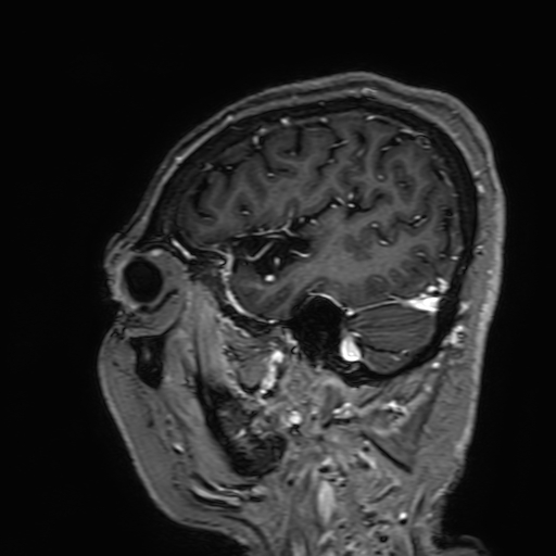 Cavernous hemangioma of the cerebellar falx (Radiopaedia 73025-83724 Sagittal T1 C+ 40).jpg