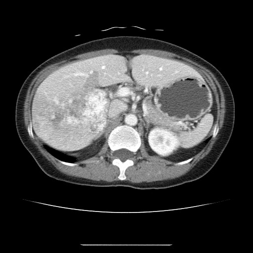 Cavernous hepatic hemangioma (Radiopaedia 75441-86667 B 36).jpg